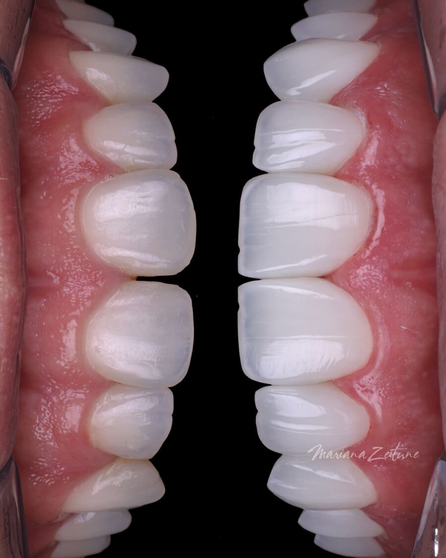 Facetas em resina composta, vista frontal