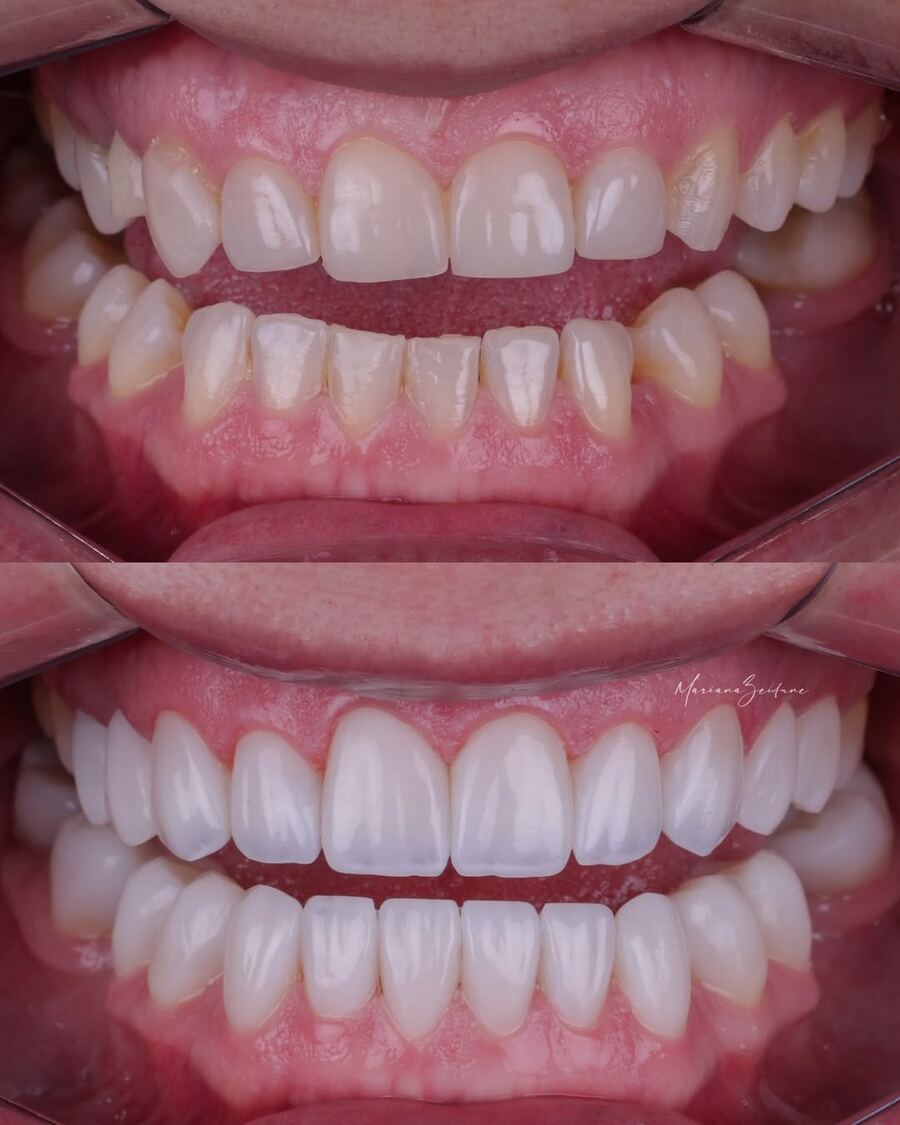 Antes e depois de facetas em resina composta