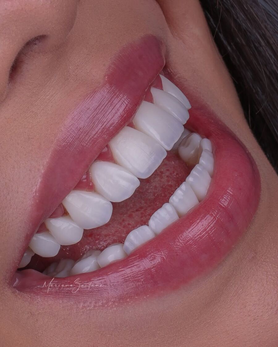 Sorriso com lentes em resina composta