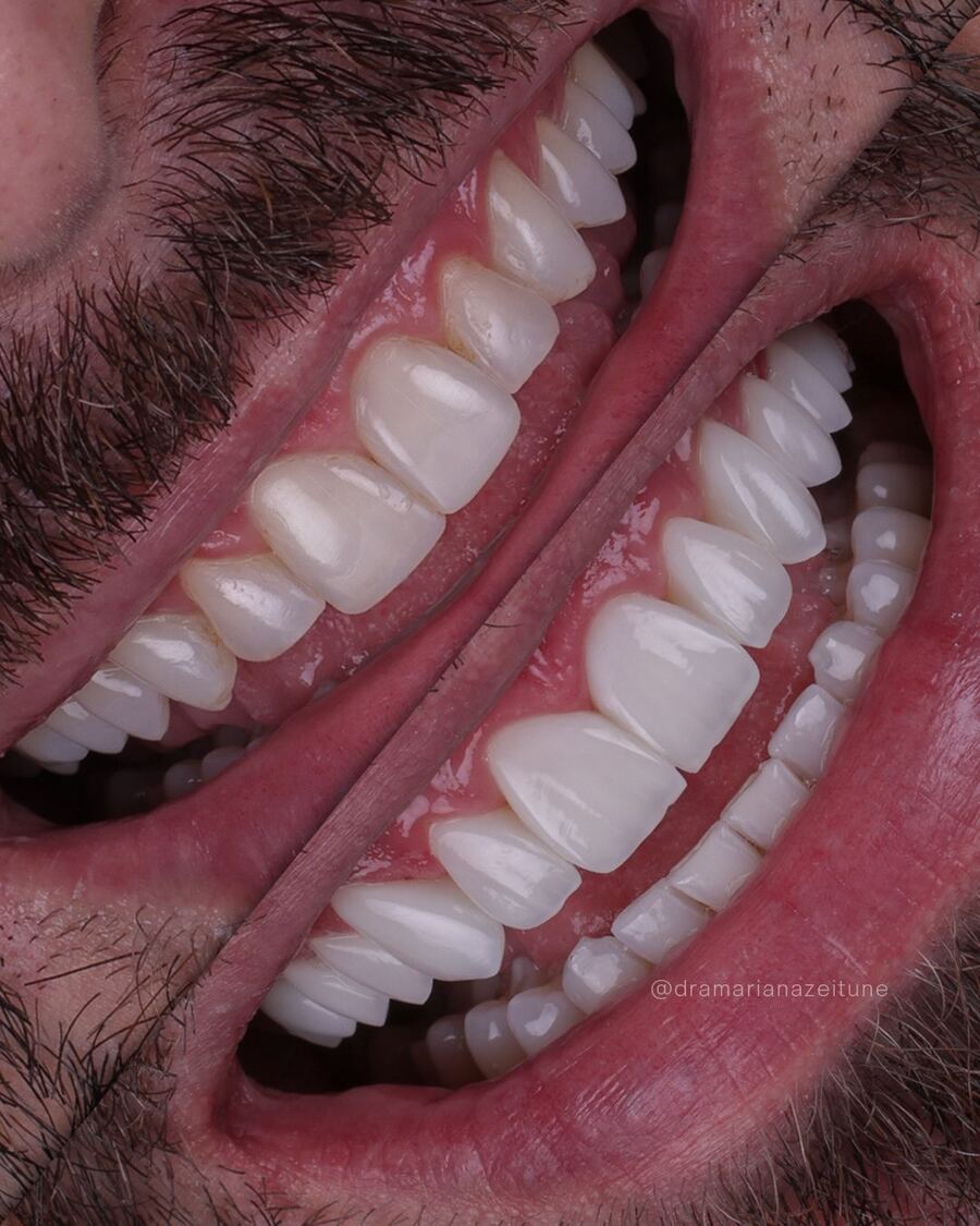 Facetas em resina composta, vista lateral