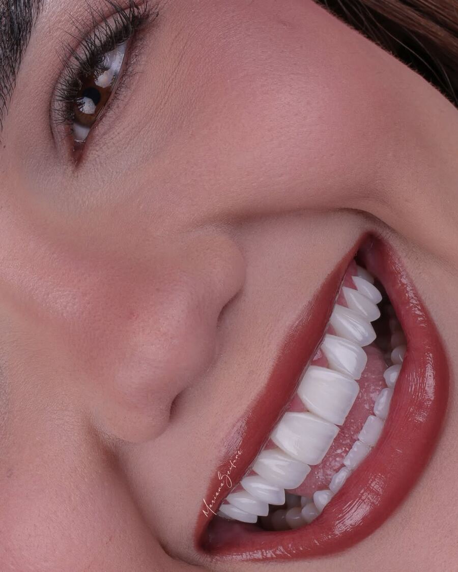 Sorriso com facetas em resina composta