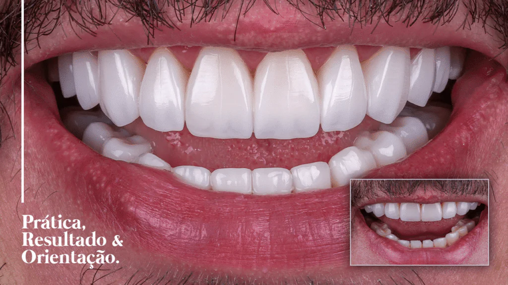 Caso 011 de facetas em resina, antes e depois