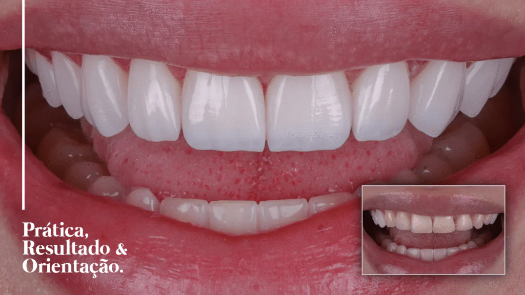 Caso 010 de facetas em resina, antes e depois