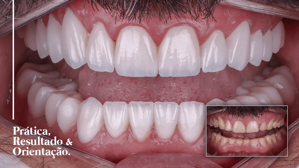 Caso 007 de facetas em resina, antes e depois
