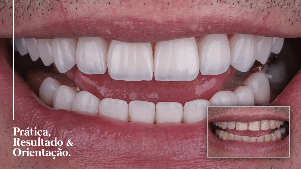 Caso 005 de facetas em resina, antes e depois