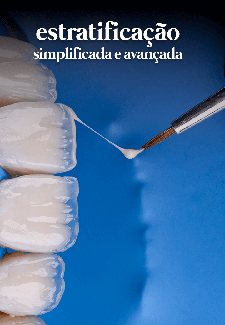 Estratificacao-Lentes-Resina.png
